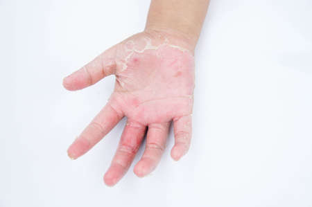 手の皮 接触性皮膚炎 真菌感染症 皮膚感染の暴露からを乾燥します の写真素材 画像素材 Image 手の皮 接触性皮膚炎 真菌感染症 皮膚感染の暴露からを乾燥します の写真素材 画像素材 Image