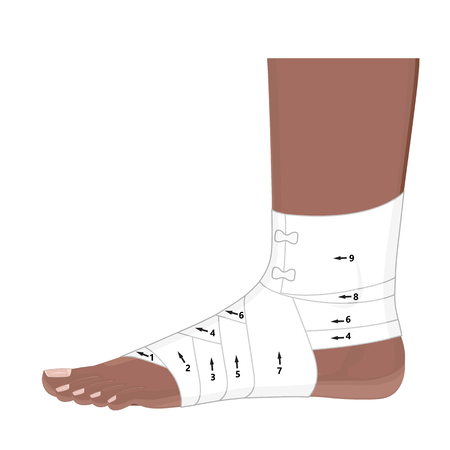 Vector illustration. correct way to wrap aframerican human ankle by flexible elastic supportive orthopedic bandage (sprain, strain). lateral view. for advertising, medical publications. eps 8. Stock Photo