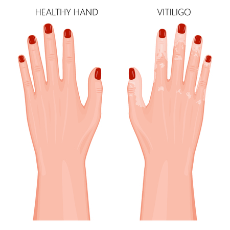 赤い爪と健康な足と白斑 皮膚色の損失と足のベクトル図です 背側のビュー 広告 医療出版物 Eps 8 のイラスト素材 ベクタ Image