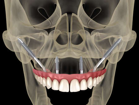 Maxillary prosthesis supported by zygomatic implants. medically accurate 3d illustration of human teeth and dentures Stock Photo