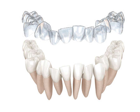 Aparat invisalign lub niewidoczny aparat retencyjny korygują zgryz. medycznie dokładna animacja 3d Zdjęcie Seryjne