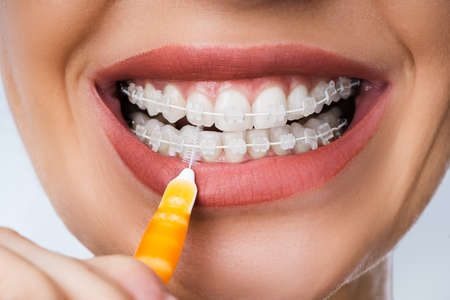 Kobieta czyszcząca zamki dentystyczne w ustach za pomocą szczoteczki do zębów