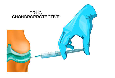 関節の注射治療のベクトル イラスト のイラスト素材 ベクタ Image