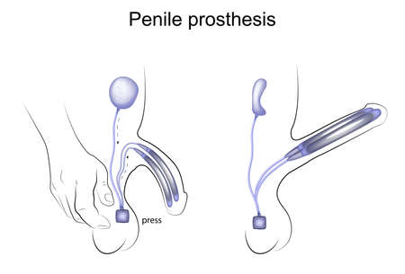 Penis implantat