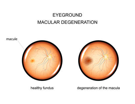vector illustration of the fundus degeneration of the macula