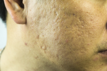 クローズ アップの頬 重度のにきびの問題のある肌やニキビ跡 にきびの少女に深いニキビ跡で肌の皮脂生産の障害の男のにきび病変に直面するため の写真素材 画像素材 Image 56084179