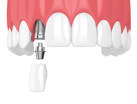 lateral incisor