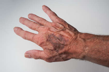 Bruises and Blood Spots Under the Skin that occur on older people Stock Photo - 82855899