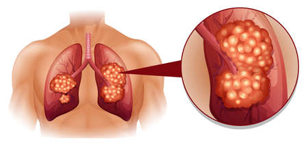 Lung cancer diagram in details illustration Illustration