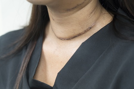甲状腺手術後の女性の首に手術傷跡を投稿 の写真素材 画像素材 Image