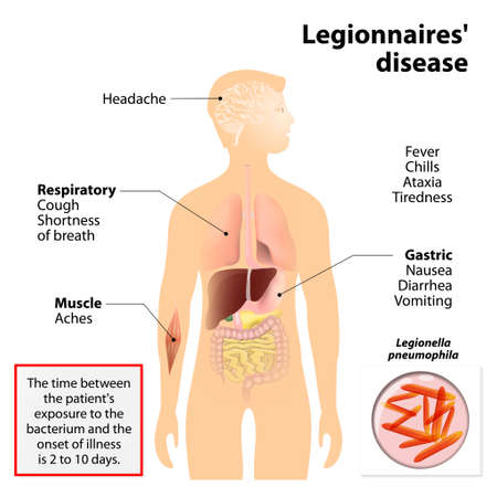 La Maladie Du Legionnaire Ou Legionellose Ou La Fievre De La Legion Les Signes Et Symptomes Est Une Forme De Pneumonie Atypique Silhouette Humaine Avec Les Organes Internes Mis En Evidence Clip