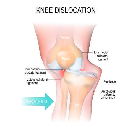lesion de rodilla ligamentos laterales