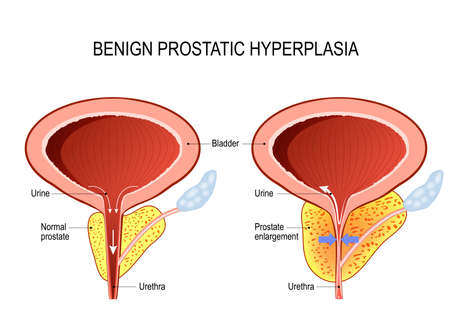 hipertrofie prostatica benigna