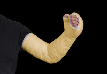 黄色の長い腕石膏のクローズ アップ グラスファイバー キャスト N 事故の黒に分離された後の手首 腕 肘をカバー の写真素材 画像素材 Image