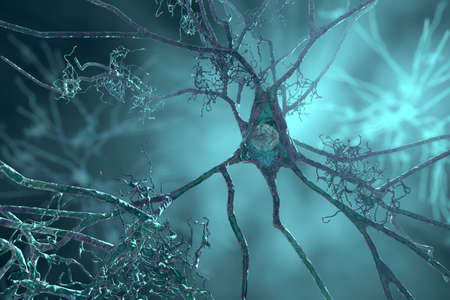 Neurons in dementia. alzheimer's disease, huntington's disease. 3d illustration showing amyloid plaques in brain tissue, neurofibrillary tangles and distruction of neuronal networks