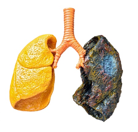 A plastic model of human lungs showing consequences of smoking Stock Photo A plastic model of human lungs showing consequences of smoking Stock Photo - 13594082