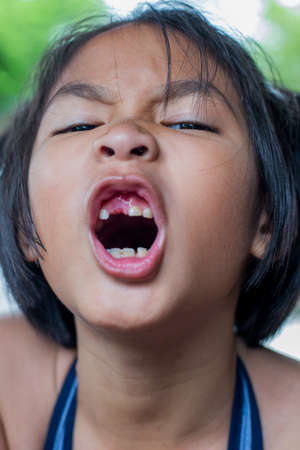 Closeup smiling little asian girl with a broken teeth