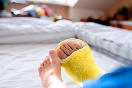 Broken Leg In Cast Of Unrecognizable Little Boy Sitting On Bed Stock Photo Broken Leg In Cast Of Unrecognizable Little Boy Sitting On Bed Stock Photo