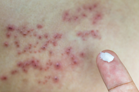 protuberancia blanca que no explotará