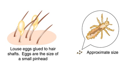 Dibujo de huevos de piojos pegados a los ejes del pelo y un dibujo ampliado de un piojo de la cabeza - 15059115
