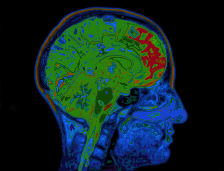 MRI immagine della testa Mostrando Cervello Archivio Fotografico - 44349697