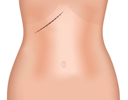 正中線 中央 切開傷 の写真素材 画像素材 Image 正中線 中央 切開傷 の写真素材 画像素材 Image