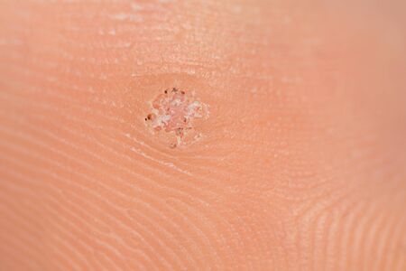 Close-up macro of a plantar wart on the bottom of a foot caused by the human papillomavirus, or HPV - 136527741