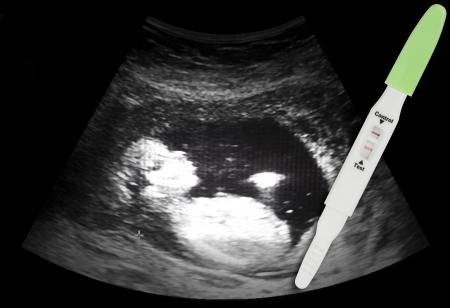 Film D Echographie De Treize Semaines Foetus Avec Test De Grossesse Banque D Images Et Photos Libres De Droits Image