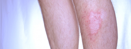 感染した皮膚病白斑 皮膚の色素の損失 の写真素材 画像素材 Image 感染した皮膚病白斑 皮膚の色素の損失 の写真素材 画像素材 Image