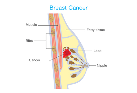 Das Wachstum Der Zelle Brustkrebs In Woman This Illustration Uber Die Medizinische Seitenansicht Lizenzfrei Nutzbare Vektorgrafiken Clip Arts Illustrationen Image 57014137