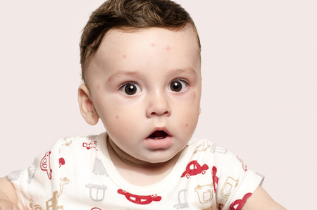 1 846 Rubella Stock Photos And Images 123rf 1 846 Rubella Stock Photos And Images 123rf