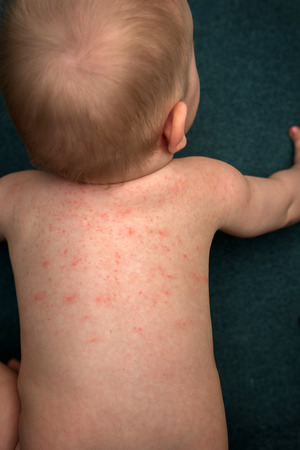 アレルギー 赤ちゃんの肌にニキビ 食物アレルギー 皮膚病 症状 の写真素材 画像素材 Image アレルギー 赤ちゃんの肌にニキビ 食物アレルギー 皮膚病 症状 の写真素材 画像素材 Image