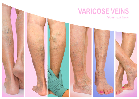 varicose palms fotografii de la varicoză și severitate în picioare