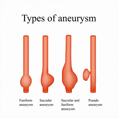 types of aneurysms
