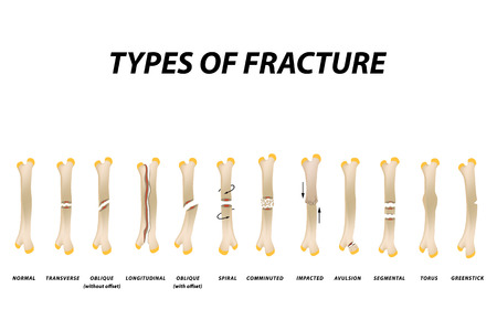 21 694 骨折 のイラスト素材 ベクター 123rf 21 694 骨折 のイラスト素材 ベクター 123rf