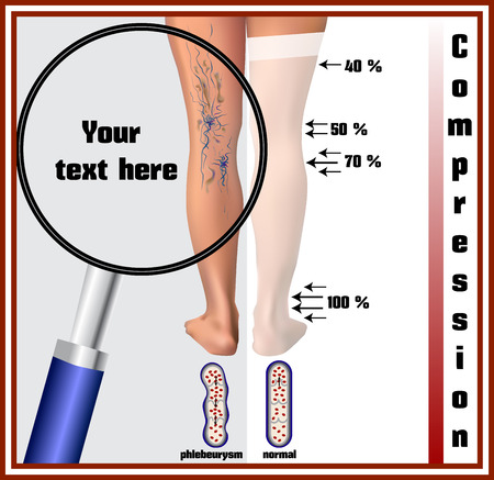 phlebeurysm treatment