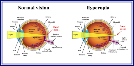 hyperopia és amblyopia kezelés lézeres látás