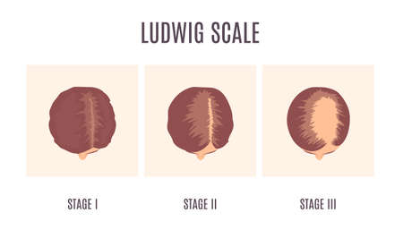 Haarverlies volgens het vrouwelijk patroon volgens de schaal van ludwig. 3 stadia van kaalheid bij vrouwen. classificatie van alopecia weergegeven op een hoofd in bovenaanzicht. schoonheid en gezondheidszorg concept. medische vectorillustratie. Stockfoto