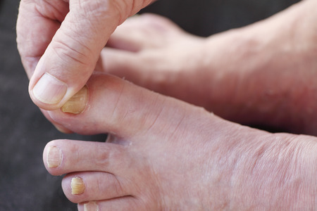 Un Homme éplucher Ses Athlètes Pied Peau Sèche Banque D Un Homme éplucher Ses Athlètes Pied Peau Sèche Banque D