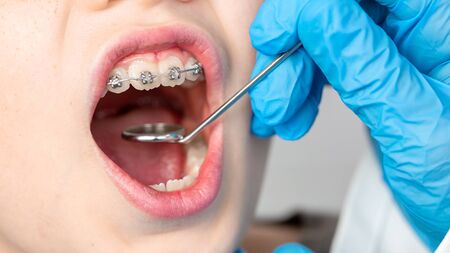 Zbliżenie dentysty za pomocą instrumentu do wizualizacji zębów dziecka pacjenta