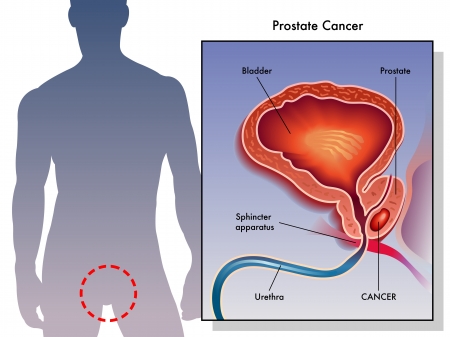 biopsia de prostata en ancianos