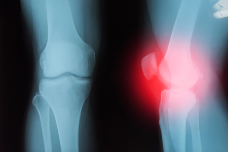 Film Rontgen Kniegelenk Mit Arthritis Gicht Rheumatoide Arthritis Septische Arthritis Osteoarthritis Knie Und Leere Flache Auf Der Linken Seite Lizenzfreie Fotos Bilder Und Stock Fotografie Image 82172563