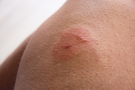 Photo D Une Piqure D Insecte Sur La Peau Double Piqure D Insecte Abeille Guepe Taon Avec Rougeur Zone D Inflammation Et Gonflement Allergique Ou Deme Sur La Peau Humaine Signes Et Symptomes De Lesions Cutanees