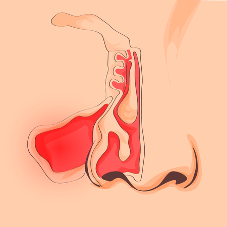 鼻と喉の解剖学 人間器官の構造 副鼻腔炎 Rinitis 鼻の痛みイラスト のイラスト素材 ベクタ Image 鼻と喉の解剖学 人間器官の構造 副鼻腔炎 Rinitis 鼻の痛みイラスト のイラスト素材 ベクタ Image
