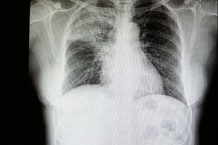 a chest xray film of a patient with lobar pneumonia of his right