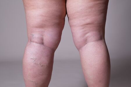 Varicose veins closeup fat female cellulite legs on a gray background 版權商用圖片