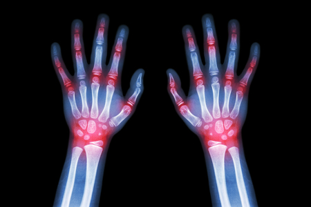 Arthritis xray pics