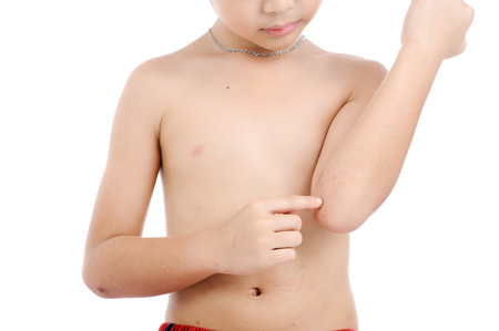 少年は 白い背景に分離された彼の体の皮膚に巻かれた乾燥かゆみから痛みを感じる の写真素材 画像素材 Image