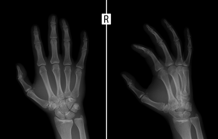 手の X 線写真 右手の第 2 指基節骨の基盤の破壊を示しています の写真素材 画像素材 Image 78162464