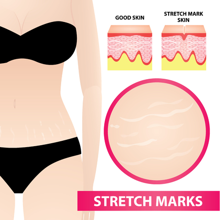 女性ストレッチマークスキンイラスト のイラスト素材 ベクタ Image